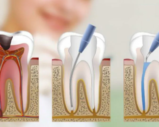 Повторное лечение корневых каналов зуба
