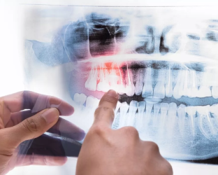 Ортопантомограмма зубных рядов (ОПТГ)