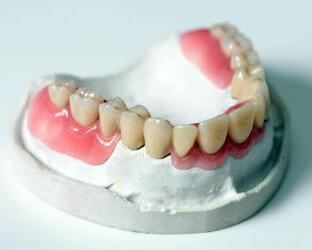 Зубные протезы Квадротти (QuattroTi)