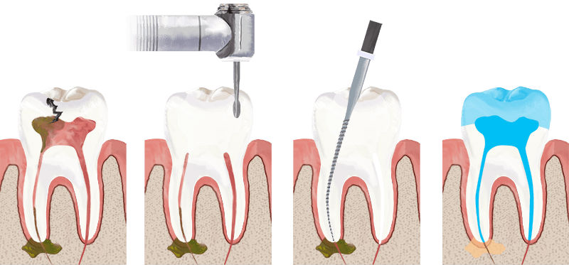 лечение корневых каналов зубов и прикорневых тканей